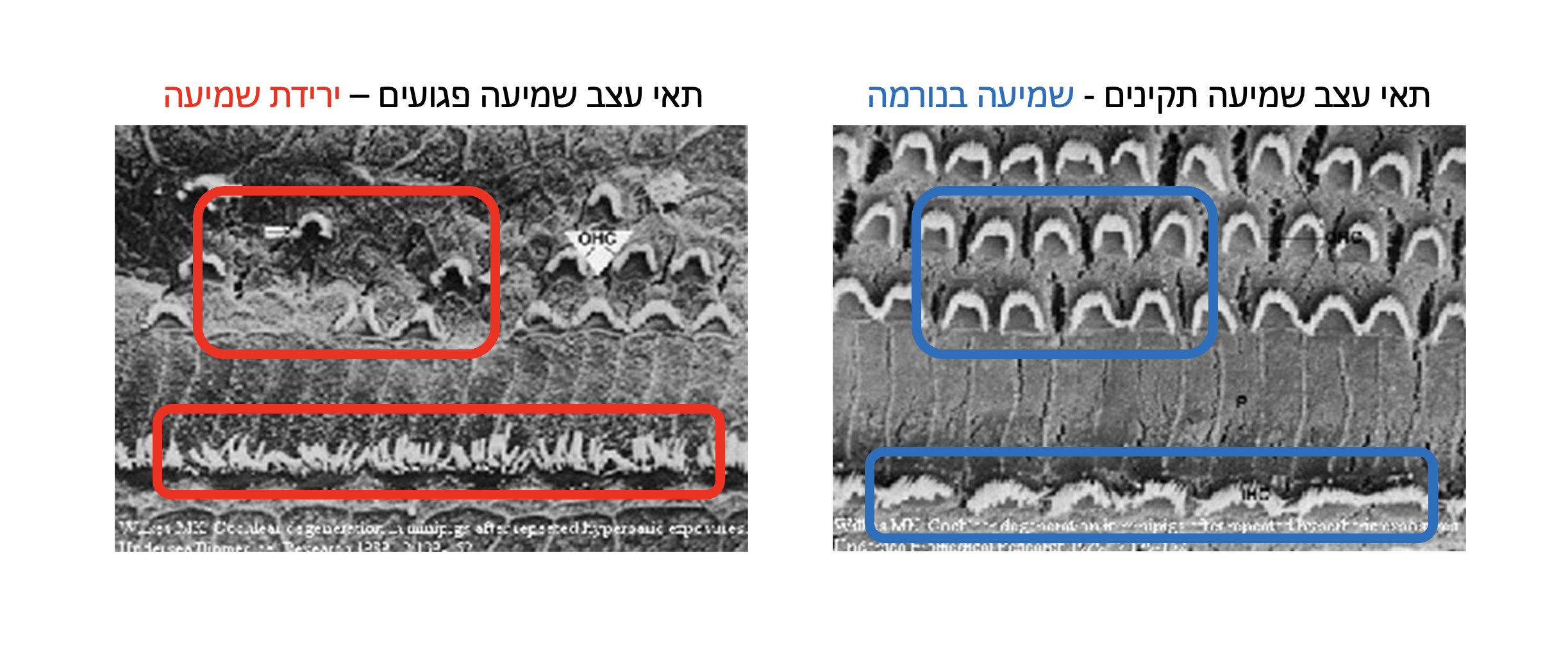 ירידת שמיעה פגיעה בעצב השמיעה בשל ירידת שמיעה צילום עצב שמיעה גל מכשירי שמיעה