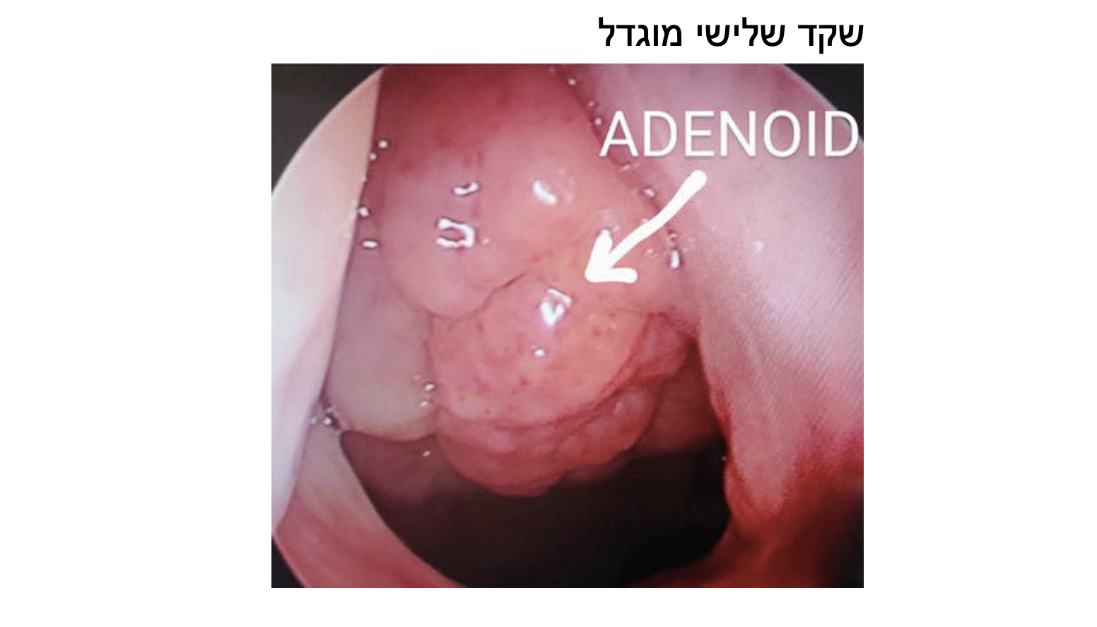 שקד שלישי מוגדל אדנואיד מדולק
